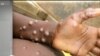 WHO Ta Ce An Samu Cutar Kyandar Biri A Kasashe 12 - Monkey Pox