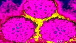 Oral Cancer Caused by HPV Soars in Developed Countries